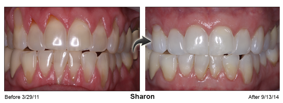 gum recession treatment San Jose