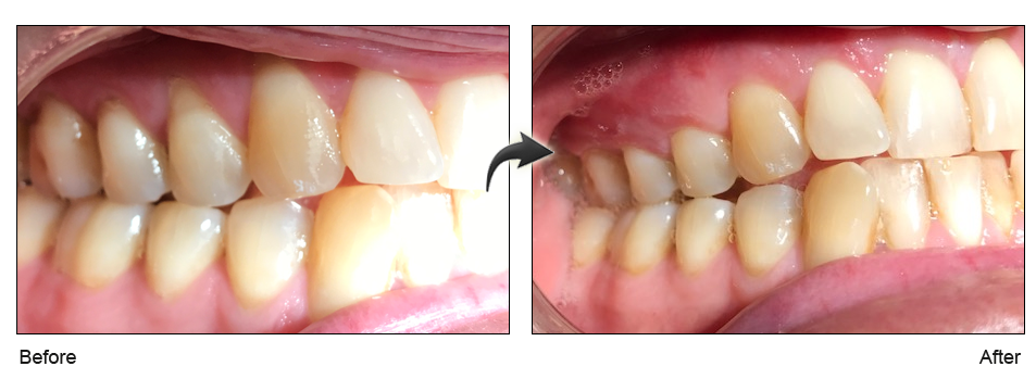 gum recession treatment san jose