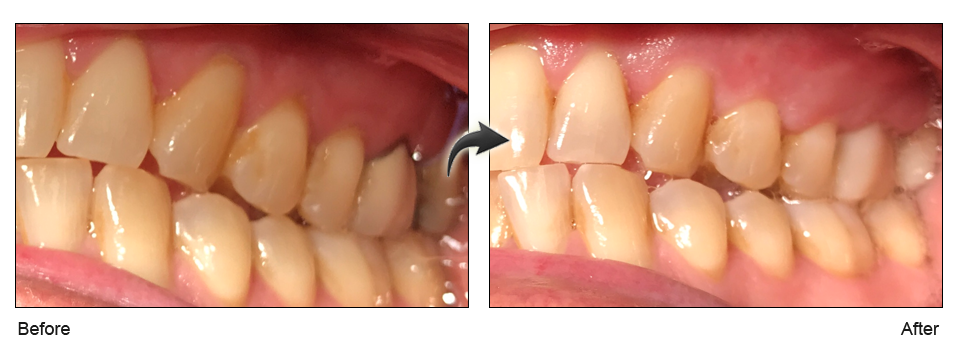 gum recession treatment San Jose