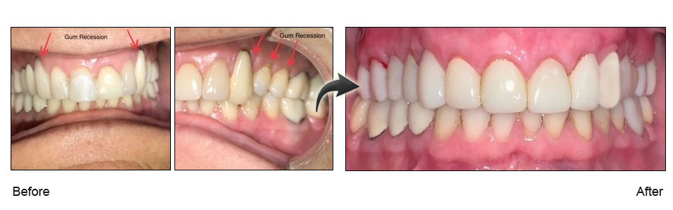 fix gum recession San Jose